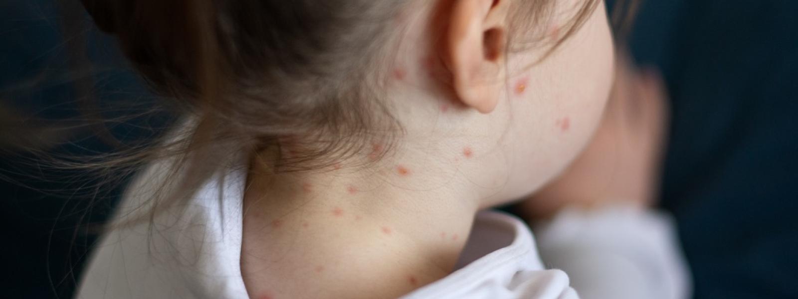 Small Girl With Chickenpox Measles on Her Body